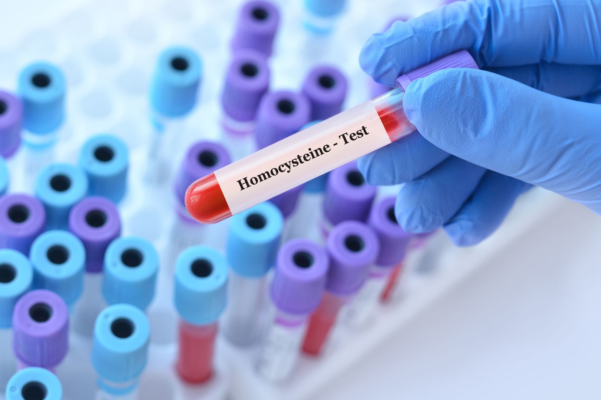 Homocysteine in the blood - what are the standards?